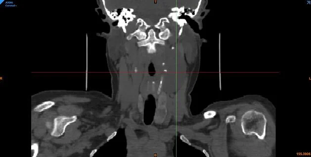 Plano coronal del shwannoma mandibular