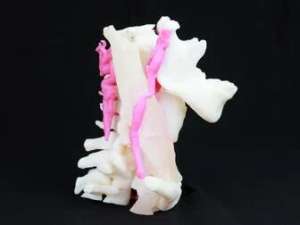 Schwannoma mandibular impreso en 3D