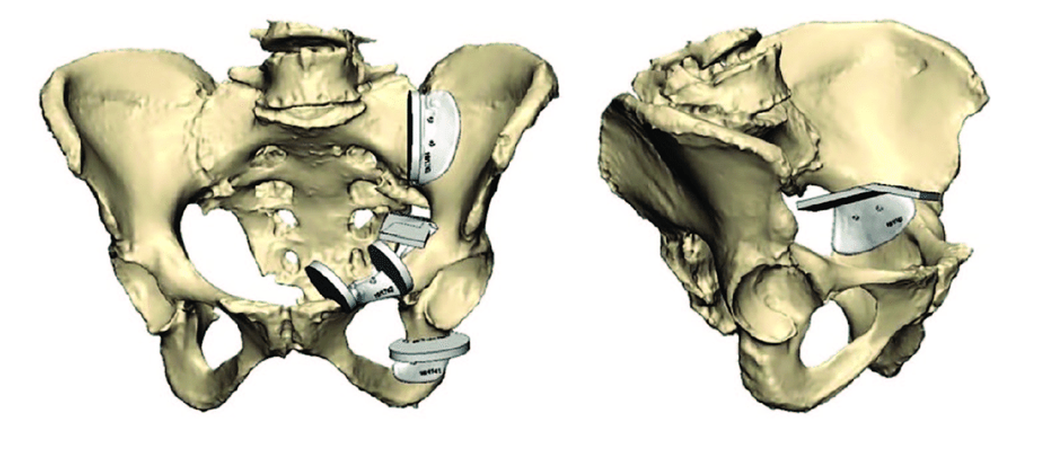 modelo 3d guías quirúrgicas 