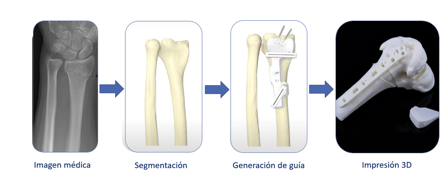 proceso de creación de guías prequirúrgicas