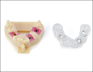 Modelo dental impreso en 3D con guía quirurgica